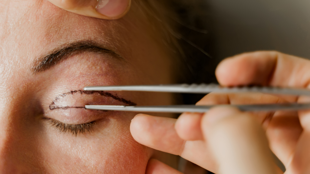 La cirugía de párpados permite recuperar frescura y expresión respetando los tejidos y preservando la naturalidad del rostro.